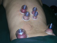 cupping_01