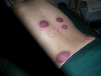 cupping_02